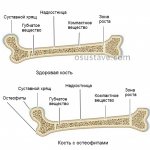 здоровая кость и с остеофитами