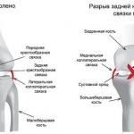Healthy knee and posterior cruciate ligament rupture