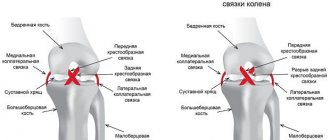 Здоровое колено и разрыв задней крестообразной связки